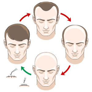 men hair loss